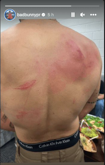 Bad Bunny muestra su espalda con arañazos y hematomas tras pelea en la WWE - bad-bunny-muestra-su-espalda-con-aranazos-y-hematomas-tras-pelea-en-la-wwe